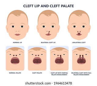 Cleft lip birth defect baby face nose Born gene drink bifid uvula roof Oral