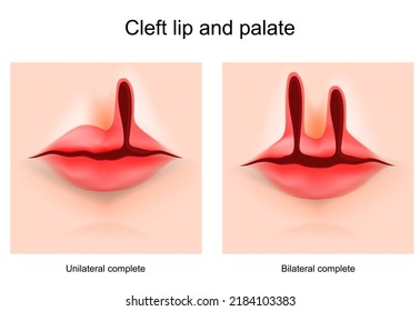 Cleft lip and cleft palate. face of a child with a defect cleft. Hare-lip. Unilateral and bilateral complete. Vector poster