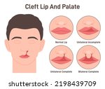 Cleft lip and cleft palate. Harelip. Human face with a birth defect. Unilateral and bilateral complete. Openings or splits in the upper lip extended into the nose. Flat vector illustration