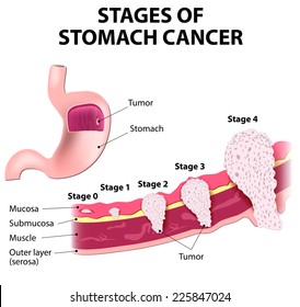 The Clinical Stages Of Stomach Cancer. Classification Of Malignant Tumours