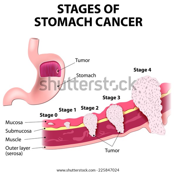 Clinical Stages Stomach Cancer Classification Malignant Stock Vector ...