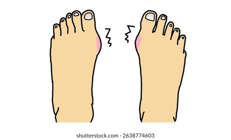 clip art of hallux valgus