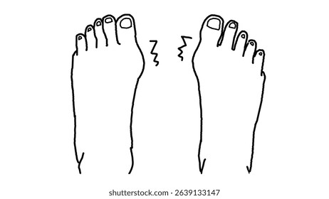 clip art of hallux valgus