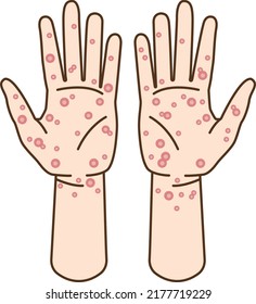 Clip Art Of Hand Of Syphilis And Skin Disease