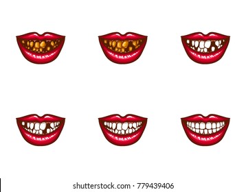 Clipart of vector female mouths with dental problems. Spoiled, darkened, nasty, crooked teeth, tooth loss, gums disease and white perfect healthy smile. Pop art style illustration. Isolated elements