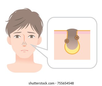 clogged pores on nose of young men’s face. men’s skin care and beauty concept