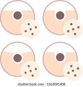 clogged pores, sagging, bumpy pores, darkening and large pores