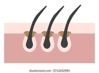 Poros obstruidos con la ilustración de la sección transversal del enchufe del sebo para el cuidado de la piel y la dermatología