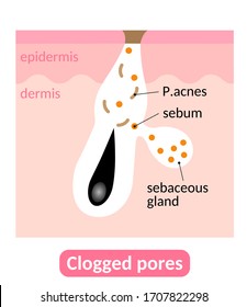 clogged pores skin layer. excess sebum lead to pore clogging. Healthy skin care concept. Isolate on white background