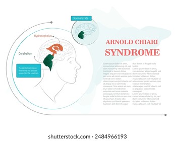 A close up of a brain with the word Arnold Chiari Syndrome written below it. The image is in blue and white