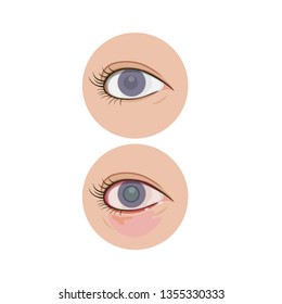 Close up eye with cataract on white background.