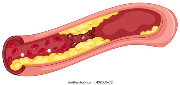 Close Up Picture Of Blood Clot Illustration