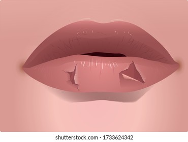 Close Up Picture Of Cracked Lips - Vector