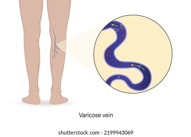 Close Up Of Varicose Veins. Cross Section Of Varicose Vein. Vector For Use In Scientific Study And Medical Treatment.