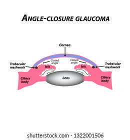 Closed angle glaucoma. A common type of glaucoma. The anatomical structure of the eye. Infographics. Vector illustration on isolated background.