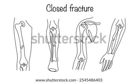 Closed fracture. Violation of the integrity of bone tissue, in which the skin and mucous membranes are not damaged. Line-drawn options for closed bone fractures. Medical vector.
