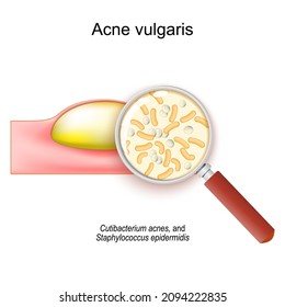 Close-up of Acne vulgaris. Cross-section of a human skin with pimple. Magnifying glass and bacteria that cause of acne. Cutibacterium acnes, and Staphylococcus epidermidis. Vector illustration