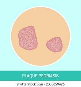 Closeup Cracked Skin With Plaque Psoriasis Vector Illustration. Circle Icon With Text Sign. Image Of Skin With Plaque Psoriasis Close Up For Medical Articles, Posters And Banners.