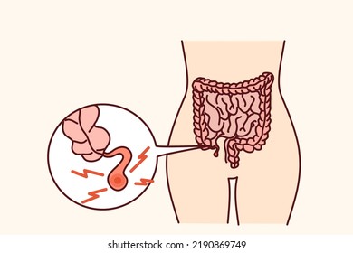 Cierre del cuerpo humano con apéndice inflamado. La persona que sufre apendicitis necesita cirugía. Ilustración vectorial. 