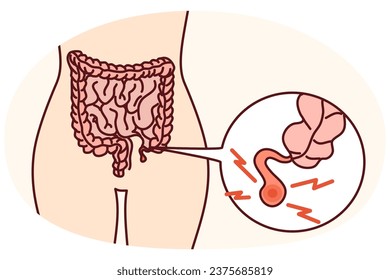 Closeup of human body with inflamed appendix. Person suffer from appendicitis need surgery. Vector illustration.