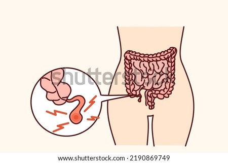 Closeup of human body with inflamed appendix. Person suffer from appendicitis need surgery. Vector illustration. 