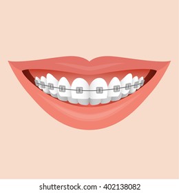 Closeup  Human Lips Smile with Metal Braces