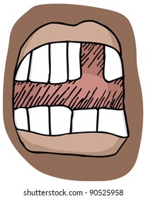 Close-up illustration of an open mouth with a missing tooth