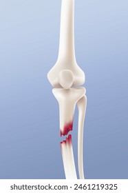 Close-up image of broken leg bone. Realistic vector illustration.