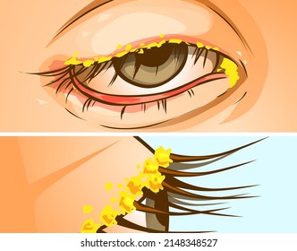 Closeup image of the disease of the eye. Blepharitis. Inflammation along the edges of the eyelids. Healthcare illustration, medical illustration. Vector illustration. 