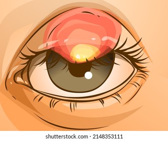 Closeup image of the disease of the eye. The human eye with the stye. Healthcare problems. Medical illustration, vector illustration. 