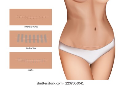 Closeup of incision with sutures. Wound closure devices Staples, Medical Tape and Stitches (Sutures). Surgical wound svg