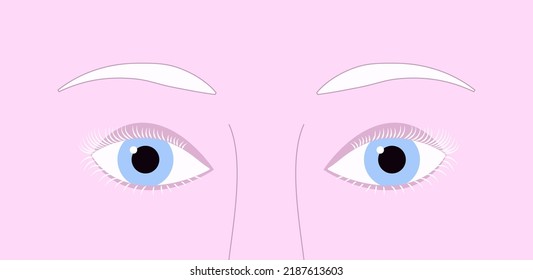 Closeup Light Blue Eyes Of Albino Person With Pink Skin And White Depigmented Eyelash And Eyebrows