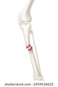 Close-up medical of shin bone fracture Used in medicine for treatment or for advertisements for specialized orthopedic hospitals. Realistic vector illustration.