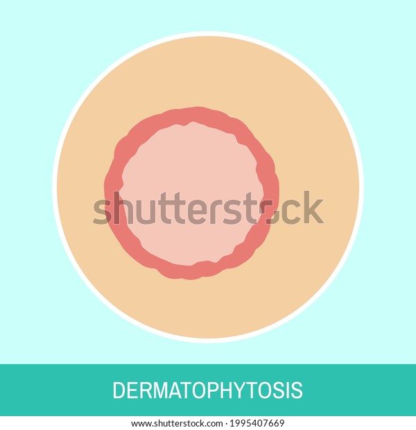 Closeup skin with fungal\
infection vector illustration. Circle icon with text sign. Image of\
skin with dermatophytosis close up for medical articles, posters\
and banners.