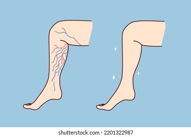 Close-up of unhealthy and healthy leg with varicose veins. Patient suffer from varicoses. Healthcare and medicine. Vector illustration. 