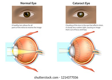 Сataract is a clouding of the lens. Medical illustration of a normal eye and an eye with a cataract, clouded lens