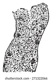 Hinchazón turbia del revestimiento epitelial del túbulo renal, ilustración vintage grabada. 