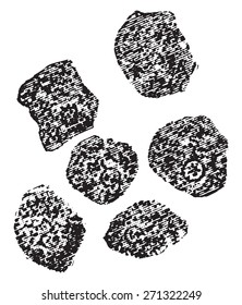 Cloudy swelling of the liver cells, vintage engraved illustration. 