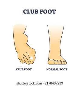 Club Foot Or Talipes For Baby That Feet Turn In And Under Outline Diagram. Labeled Educational Medical Comparison With Clubfoot And Normal Condition Vector Illustration. Disorder With Leg Curvature.