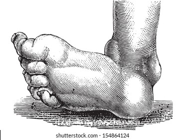 Clubfoot or congenital talipes equinovarus, vintage engraved illustration. Usual Medicine Dictionary - Paul Labarthe - 1885.