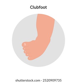 Pé torto	pé com problema. Diagrama infográfico ortopédico