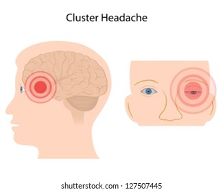 Cluster Headache