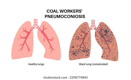 Coal workers disease concept, pneumoconiosis medical poster. CWP or black lung occupational illness, coal mine dust in the respiratory system. Shortness of breath, chest pain flat vector illustration.