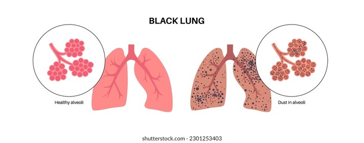 Coal workers disease concept, pneumoconiosis medical poster. CWP or black lung occupational illness, coal mine dust in the respiratory system. Shortness of breath, chest pain flat vector illustration.