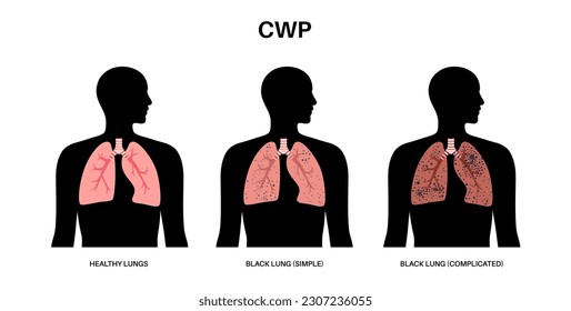 Coal workers disease concept, pneumoconiosis medical poster. CWP or black lung occupational illness, coal mine dust in the respiratory system. Shortness of breath, chest pain flat vector illustration.