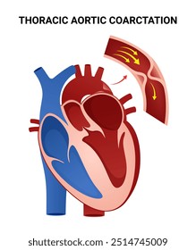 Coarctação das Causas da Aorta