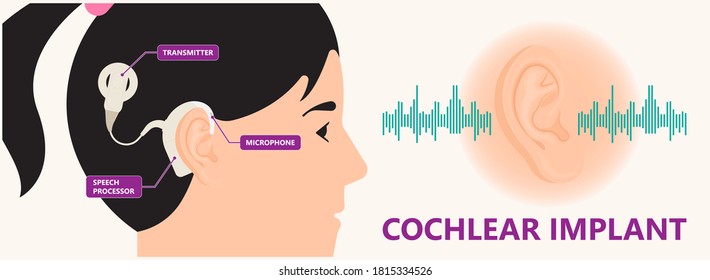 Cochlear implant device electrically stimulates nerve medical aid ear sound wave adults hard middle exam