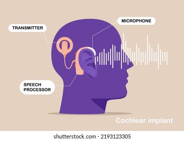 Cochlear implant device electrically stimulates nerve medical aid ear sound wave adults hard middle exam. Vector illustration.
