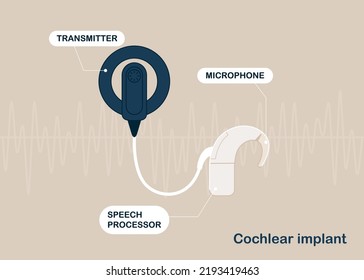 Cochlear implant device electrically stimulates nerve medical aid ear sound wave adults hard middle exam. World Deaf Day in last Sunday of September.