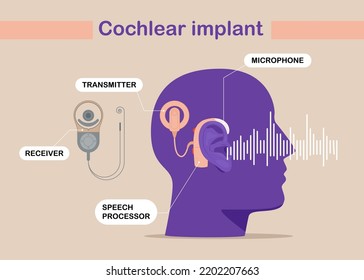 Cochlear implant device electrically stimulates nerve medical aid ear sound wave adults hard middle exam. Flat vector illustration.